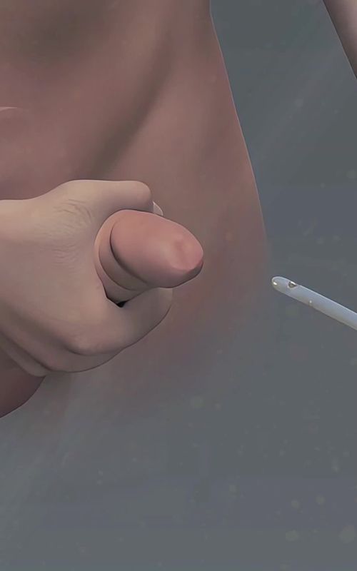 Kidney Stones Removal Surgery 3D Animation (Ureterolithotripsy) #kidneystone #kidneystones #kidneystonesurgery #kidneystoneremoval #ureteroscopy #ureterstone #ureterstonetreatment #medical3danimation #3dmedicalanimation