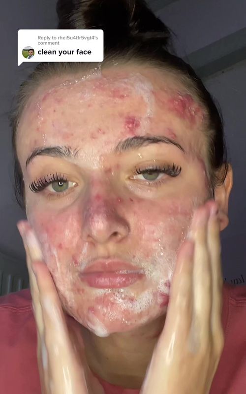 Replying to @rhei5u4tfr5vgt4 I clean my face every morning and night #skincare #acneproneskin #acnepositivity #acne #acneskin #texturedskin #skincareroutine 