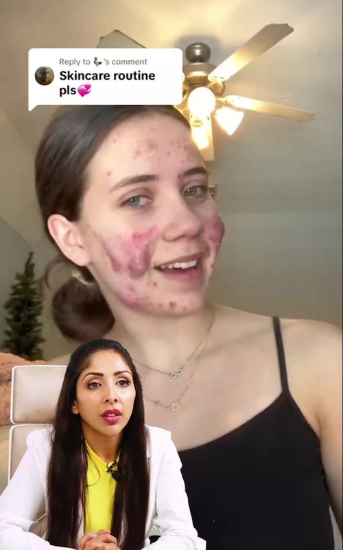 Cystic acne is one of the most painful things to treat and for skin of colour I recommend you see a dermatologist to minimise chances of scarring.  This is why our kids of colour need to understand their skin and have healthy routines to minimise excess sebum production.   Our Trio Blemish 4-piece system helps with early/ mild Acne 1. Face wash- salicylic acid, Niacinamide, anti inflammatories, humectants  2. Exfoliator- 2% salicylic acid, green tea extract, anti inflammatories 3. AM gel- Vit C, anti bacterial gel mousturiser 4. PM gel- tyrosinase inhibitors and azelic to red and brown marks Love Dr V  #skincare #skinofcolour #acne #acnescartreatment #doctor 