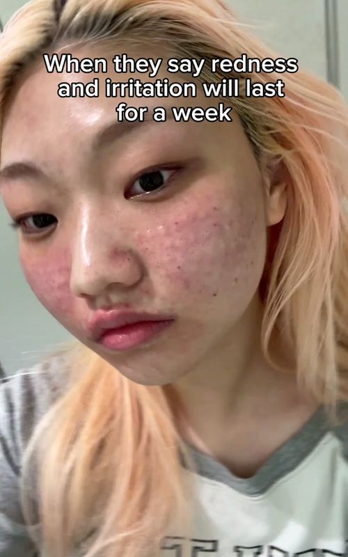 the mixsoon centella is the first thing I reach for when my skin is irritated and raw after a skin treatment (IB: @Deena) #mixsoonpartner #mixsoon #kskincare #kbeauty #beanessence #koreanskincare #glassskin #TikTokMadeMeBuyIt 