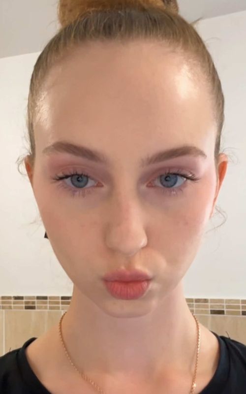 Skin glow up of the century? 🌝 - #CapCut #glowup #acneproneskin #acnetreatments #skinglowup 
