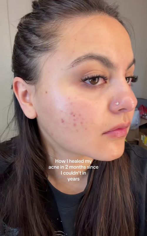 Used this cream for 60 days and this is what my skin actually looks like now. #skintok #skincare #345cream #acne 
