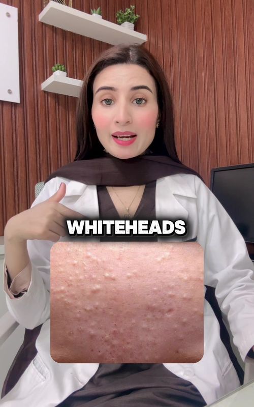 Best Treatment for Blackheads & Whitheads | Best Facewash For Acne Comedones @Dermint Glare Healthcare #skincare #skincareroutine #viral #fyp 
