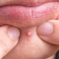 Pimples Brufoli Zits Acne