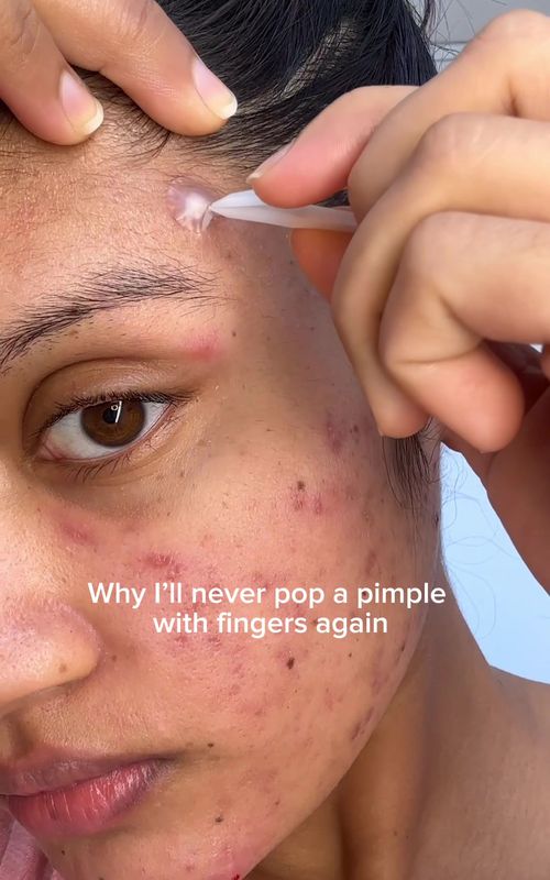 The way this pimple patch said “I got you bestie” and pulled out my entire soul 💀 The Q-tip? Soaked it up like it was born for this job. Don’t watch this while eating. You’ve been warned. #pimplepatch #acnepatch #pimplepatchremoval #pimplepatchpeel #acnepatches #cysticance #acneskin #acnetok #skintok #satisfying #patchly #grossbutsatisfying 