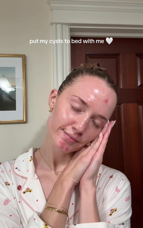 we may have a popportunity (get it?)! #cysticacne #acnejourney #acnetreatment #acnetips #nightroutine 