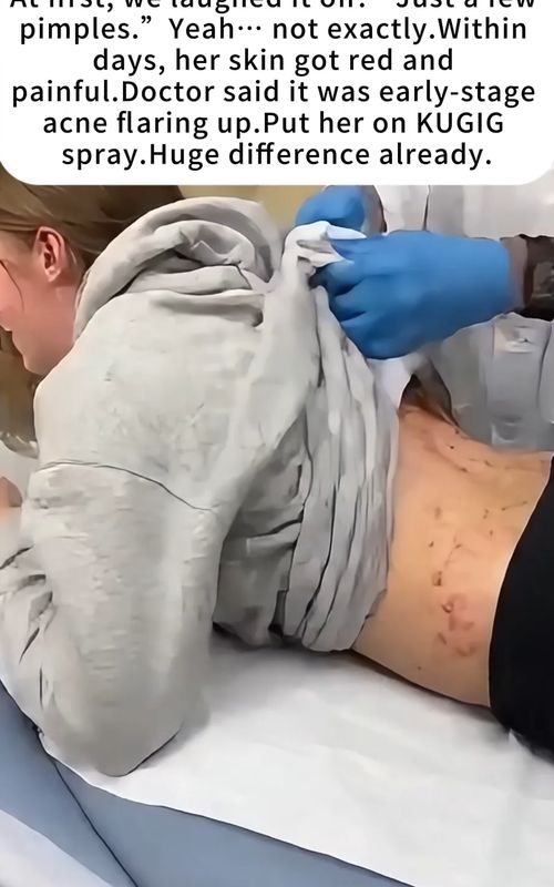At first, we laughed it off. “Just a few pimples.” Yeah… not exactly. Within days, her skin got red and painful. Doctor said it was early-stage acne flaring up. Put her on KUGIG spray. Huge difference already. #KUGIG #kugigspray #kugigancespray #acne #bodyacne #BackAcne #SkincareRoutine