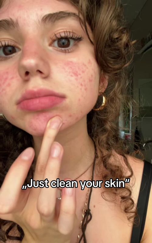 They told me to cleanse my skin, and I did it using the AcneTrack app☝🏽❤️ #acnetrack #acnegirl #clearskin #cleanyourskin #skinproblems 
