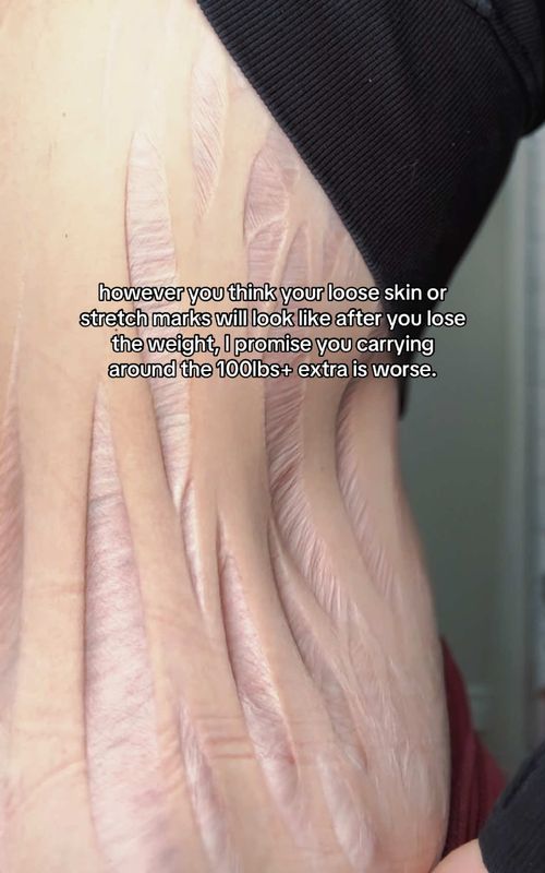 However bad you think your loose skin or stretch marks will be after you lose the weight, I promise carrying around the extra 100lbs+ is worse. I have loose skin and I have stretch marks, I lost an extreme amount of weight and my body looks nothing like someone who’s never been overweight. But I still wouldn’t go back… not for a single day. The body I was living in before was stopping me from doing literally everything and no amount of “smooth skin” would have been worth staying there. The loose skin doesn’t stop me from living my life and the stretch marks don’t stop me from living my life. But for me at 330lbs, I physically couldn’t do the things I wanted to be doing. I was out of breath, I was hiding in photos, I was saying no to things I actually wanted to say yes to. If the fear of loose skin is what’s keeping you stuck I just want you to know that staying the same would have been so much worse for me than worrying about what my body might look like on the other side.   Your body is going to change in ways you can’t prepare for and some of it will be hard. But every single version of me after losing the weight has felt more like me than the one I was stuck in before. Don’t let the fear of stretch marks and loose skin keep you from meeting the version of you that’s waiting on the other side🫶🏻