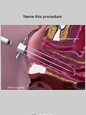 Name this procedure. . . . #fyp #foryouofficial #foryoupage #doctorsofia61 #onlyforyou #pregnancy #1millionaudition #tiktokviral @Doctor🥼 @Doctor sb 🩺 @MBBS DR 🥼 @mbbs Doctor Kainat 