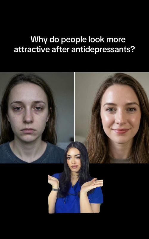 Antidepressants don’t make you prettier , they normalize mood, cortisol, and sleep, improving expressions, skin clarity, and self-care. Perceived attractiveness rises. Effects vary; some experience side effects. Mental health remains the priority. #depression #anxiety #acne #SelfCare #MentalHealth 
