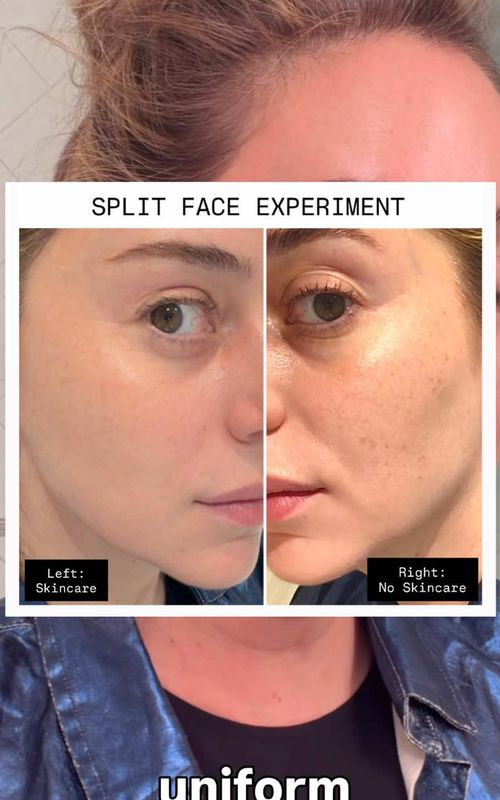 Half my face aged in 3 weeks. I’m a board-certified derm, and I quit every product on the left side of my face, except sunscreen, for 21 days. The right side? My full routine. The result: Visible photo damage reappears: sun spots + uneven tone. That is what aging looks like in real time, and that’s exactly the kind of damage a real skincare routine can prevent 👏 To everyone who says you can’t age this fast: skin doesn’t lie. Full methodology: same sleep, same diet, no driving (I’m in NYC, no car), SPF on both sides daily. #evenskintone #hyperpigmentation #darkspots #dridriss #dermatologist 