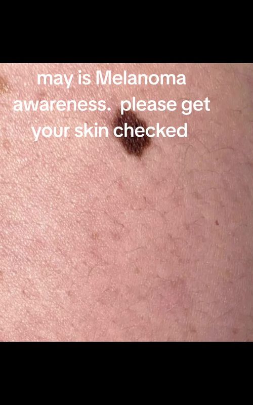 #viral #opdivo #melanoma #tiktok #fyppppppppppppppppppppppp  please schedule your full body skin check. I promise you dont want to go through this. anyone with skin NEEDS a skin check with a dermatologist at least once a year 