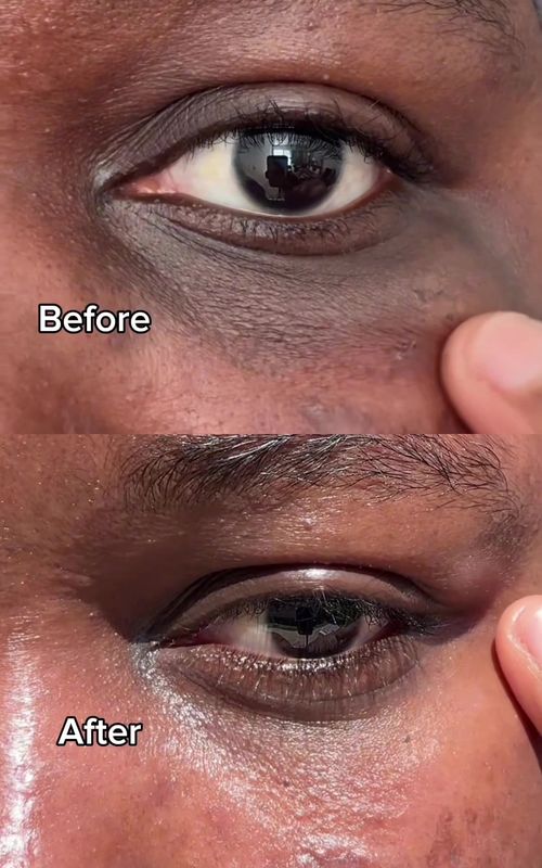 How I treat my dark under eyes. Retinol meets the Origin of NAD⁺ Skincare in K-Beauty.  #numbuzin #nadeyecream #retinoleyecream #eyecream #wrinkle @numbuzin 