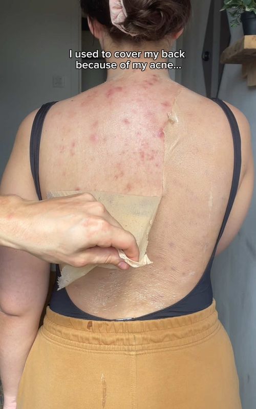 New skincare discoveries that I’m absolutely loving for my back acne!! 🤍✨ ✨Real Calendula Peel Off Pack ✨A.C.E Mugwort Centella Calming Serum ✨Carrotene IPMP Clearing Solution My skin has been feeling so much calmer and clearer since I started using these🥰 everything is from @APRILSKIN  #aprilskin #APRILSKINskincare #acneroutine #bacne #exfoliation